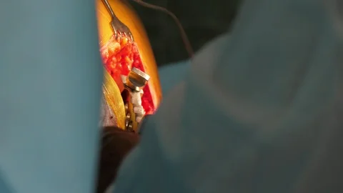 A splitting red hole on a person`s leg and two surgeons looking at it in a Video stock 111191667