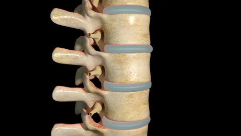 Spondylolisthesis Stock Footage 122697760