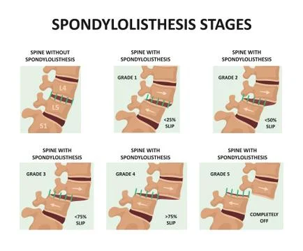 Spondylolisthesis stages Stock Illustration