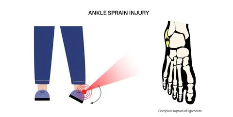 Sprained ankle injury Stock Illustration