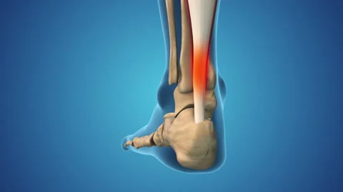 Sprained ankle pain and swollen inflammation 動画素材 276830239