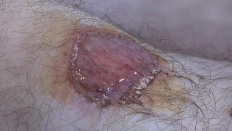 Spraying healing solution over red infected knee wound Stock Footage 97761861