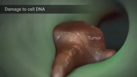 Spread of the tumor cell in the breast Stock Illustration