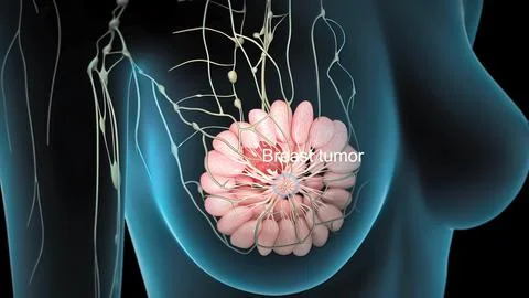 Spread of the tumor cell in the breast Stock Illustration