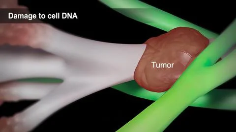 Spread of the tumor cell in the breast Stock Illustration
