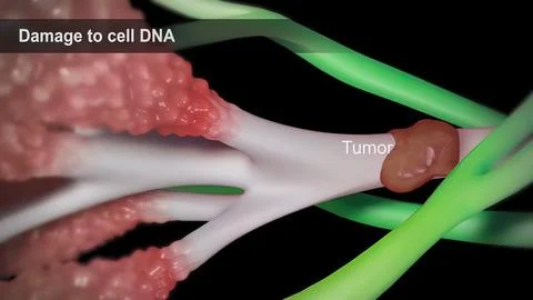Spread of the tumor cell in the breast Stock Illustration