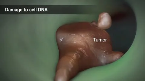 Spread of the tumor cell in the breast Stock Illustration