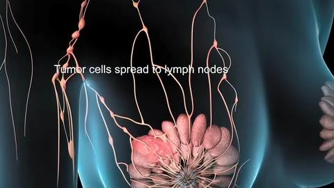 Spread of the tumor cell in the breast Stock Illustration