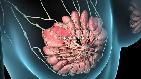 Spread of the tumor cell in the breast Stock Illustration