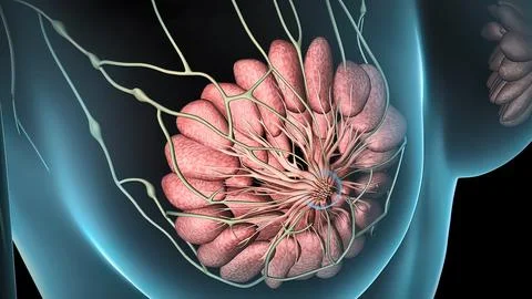 Spread of the tumor cell in the breast Stock Illustration