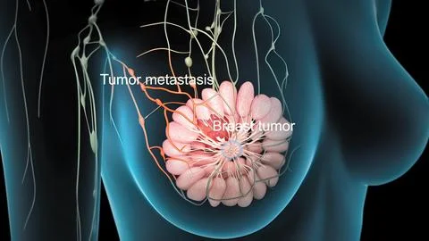 Spread of the tumor cell in the breast Stock Illustration
