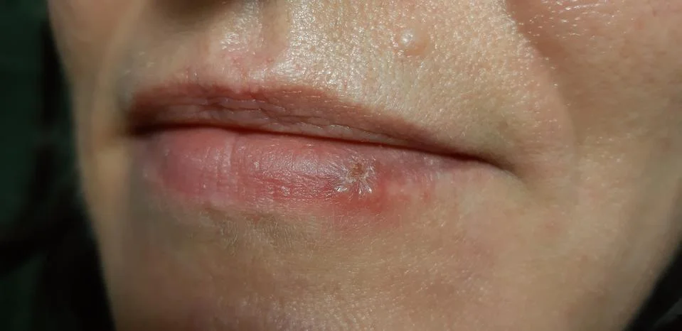 Spring reduction of immunity Stock Photos