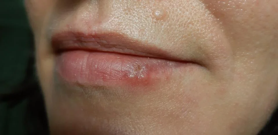 Spring reduction of immunity Stock Photos