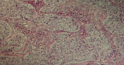 Squamous cell carcinoma, lung tissue Stock Footage 145750477