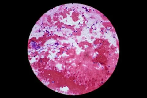 Squamous cell carcinoma of the lung is a type of lung cancer. Stock Photos