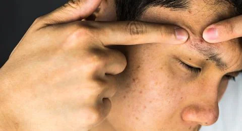 Squeeze acne, men suffer from pimples Stock Photos