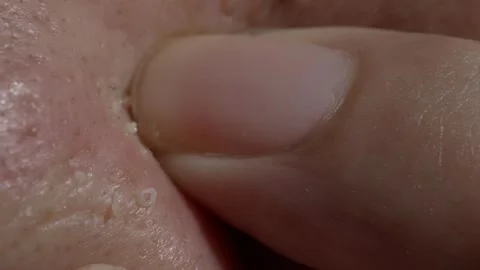 Squeezing pimples acne on the nose with hands. Stock Footage 293140012