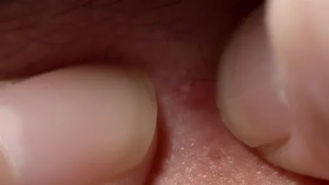 Squeezing a small cystic zit on human skin, extreme macro view 스톡 동영상 337148468