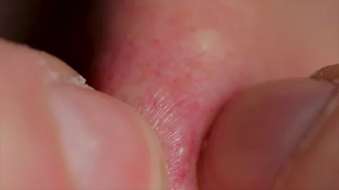 Squeezing whiteheads with nails acne close up on nose caused by wearing PPE. Ski Stock Footage 148353342