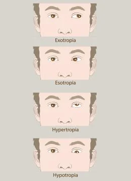 Squint Stock Illustration