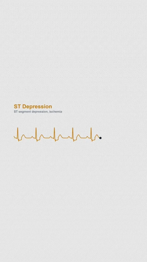 ST Depression ECG Heart Rhythm Labeled Overlay Alpha 4K Vertical 9x16 Light Видео 339507152