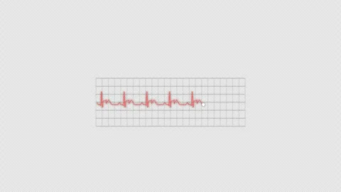 ST Elevation (STEMI) ECG Heart Rhythm Animation Alpha 4K Stock-Footage 339301672