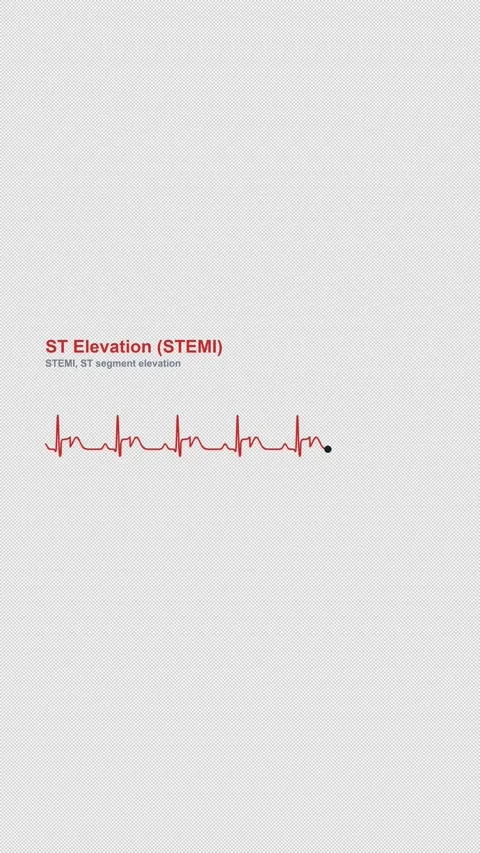ST Elevation (STEMI) ECG Heart Rhythm Labeled Alpha 4K Vertical 9x16 Light 스톡 동영상 339507170