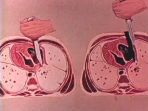 Stab wounds are explained on dead bodies at the morgue in 1975. Stock Footage 75304110