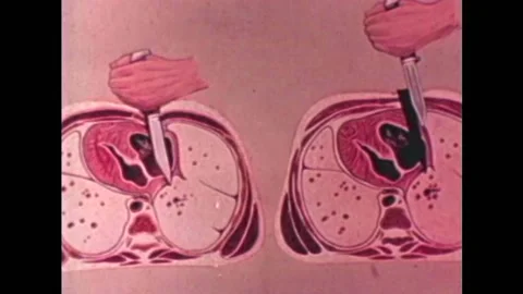Stab wounds are explained on dead bodies at the morgue in the 1960s. Stock Footage 159331140