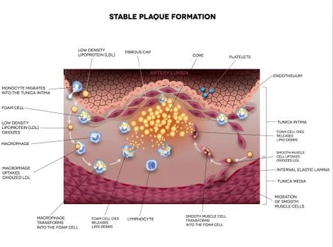 Stable plaque formation in the human artery Stock Illustration