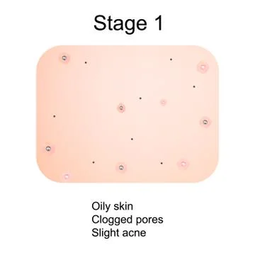 Stage 1 of development of acne. Inflamed skin with scars, acne and pimples. The Stock Illustration