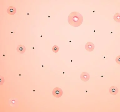 Stage 2 of development of acne. Inflamed skin with scars, acne and pimples. The Stock Illustration