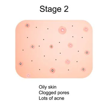 Stage 2 of development of acne. Inflamed skin with scars, acne and pimples. The Stock Illustration