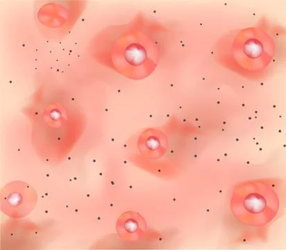 Stage 3 of development of acne. Inflamed skin with scars, acne and pimples. The Stock Illustration