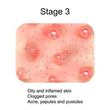 Stage 3 of development of acne. Inflamed skin with scars, acne and pimples. The Stock Illustration