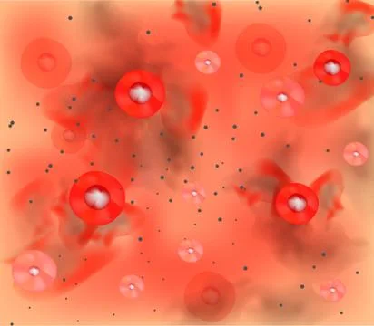 Stage 4 of development of acne. Inflamed skin with scars, acne and pimples. The Illustrazione stock