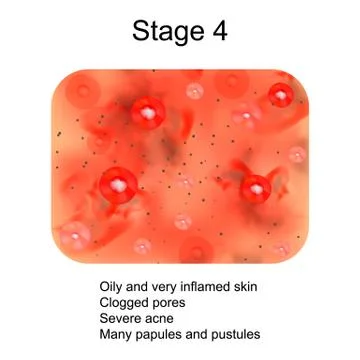 Stage 4 of development of acne. Inflamed skin with scars, acne and pimples. The Stock Illustration