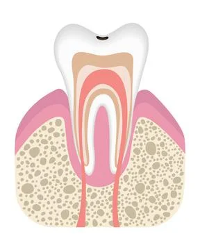 Stage of caries development. Tooth structure in flat style. Tooth decay with Illustrazione stock