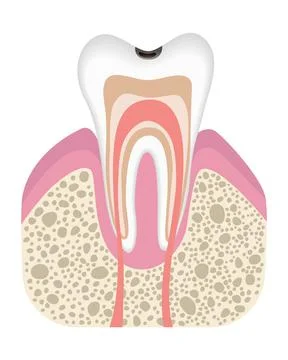 Stage of caries development. Tooth structure in flat style. Tooth decay with 스톡 일러스트