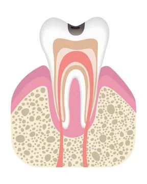 Stage of caries development. Tooth structure in flat style. Tooth decay with Illustrazione stock