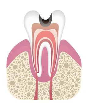 Stage of caries development. Tooth structure in flat style. Tooth decay with Illustrazione stock