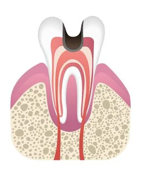 Stage of caries development. Tooth structure in flat style. Tooth decay with Stock Illustration