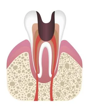 Stage of caries development. Tooth structure in flat style. Tooth decay with Illustrazione stock