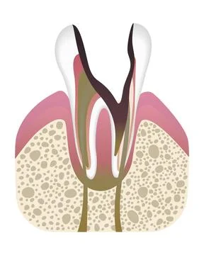 Stage of caries development. Tooth structure in flat style. Tooth decay with 스톡 일러스트