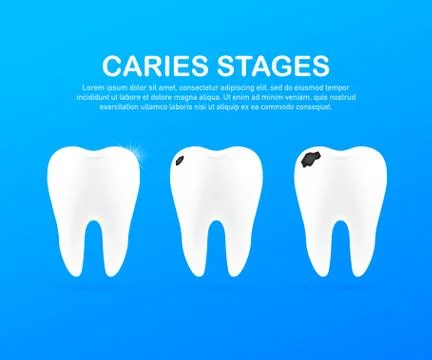Stage of development of caries. Dental care concept. Healthy Teeth. Vector il Stock Illustration