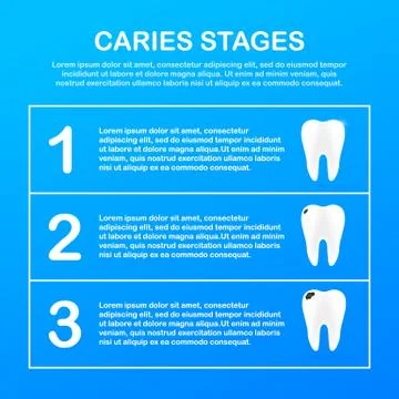 Stage of development of caries. Dental care concept. Healthy Teeth. Vector il Illustrazione stock