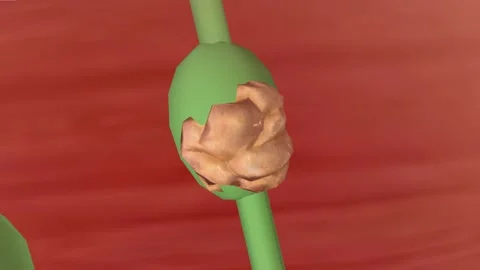 Stage II metastasis to lymph node Video stock 244667697