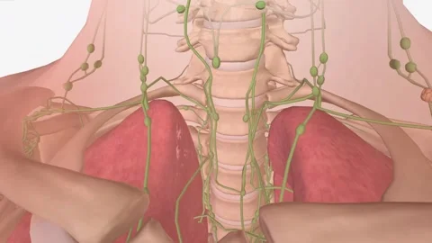 Stage IV metastasis to distant lymph nodes Видео 244668487