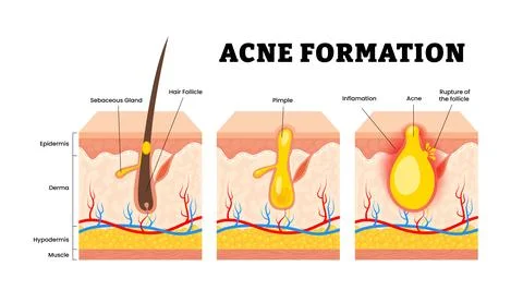 The stages of acne formation stage development process. Sebum in clogged po.. Stock-Illustration