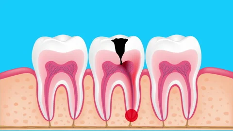 Stages of caries development. Stock Footage 132224551